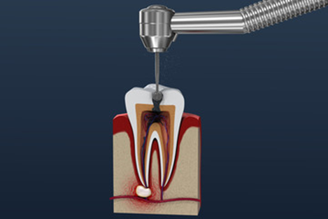 Why Does an Infection Occur Under a Dental Crown?