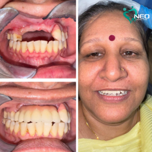 Upper Front Lost Teeth Replaced With Dental Implants And All Ceramic Crowns