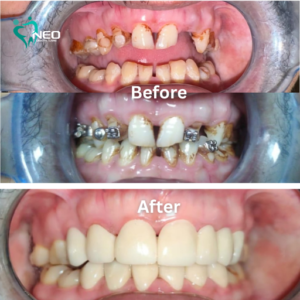 Missing Lower front teeth replaced using Dental Implants