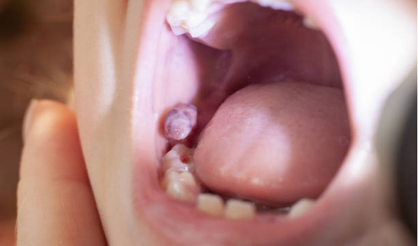 Treatment for Abscess After Tooth Extraction