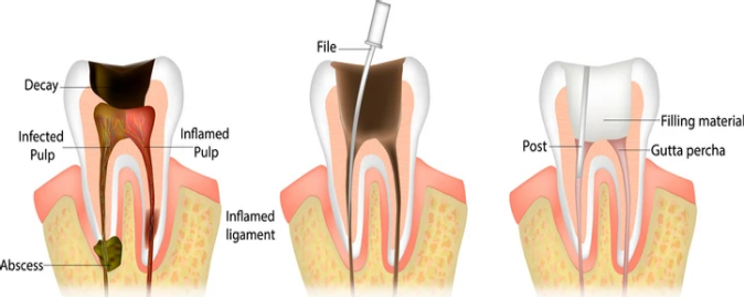 Root Canal Treatment