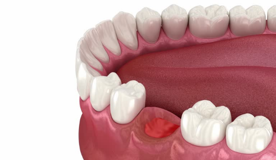 Abscess Months After Tooth Extraction