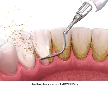 dental treatment