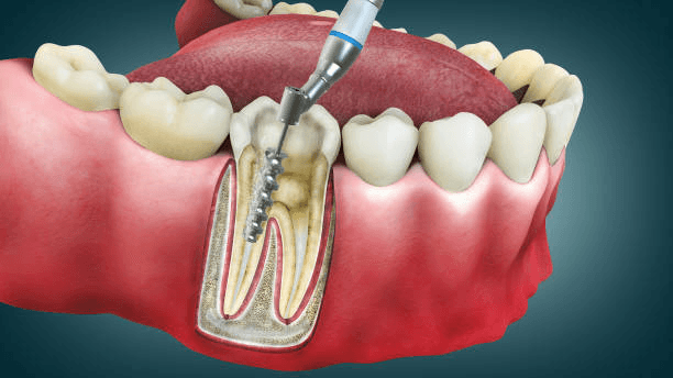 Picture2 | Neo Dental | Neo Dental root canal procedure