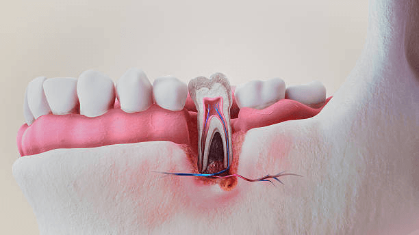 Picture3 | Neo Dental | Neo Dental Inflamed Surrounding Tissue