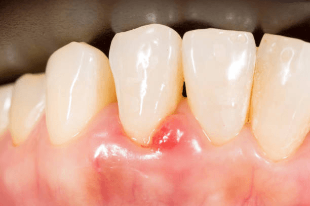 Picture4 | Neo Dental | Neo Dental High or Improper Bite