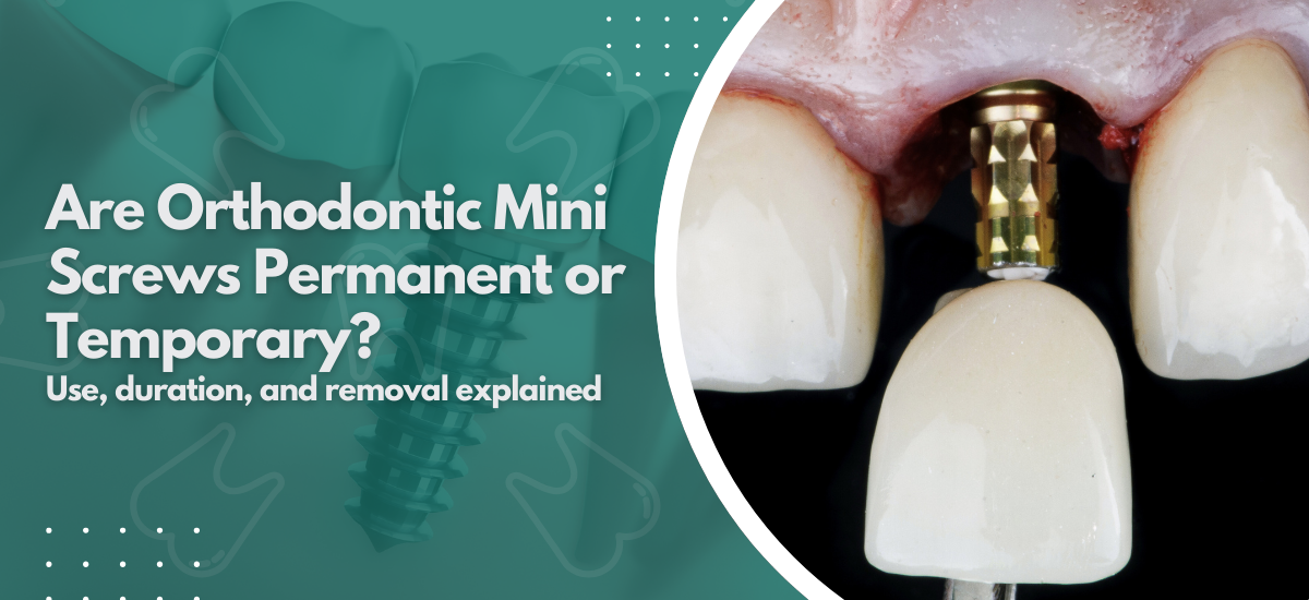 Are Orthodontic Mini Screws Permanent or Temporary?