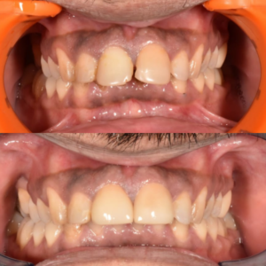 Missing Lower front teeth replaced using Dental Implants 5 | Neo Dental