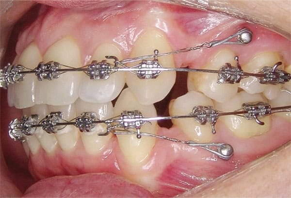 What are orthodontic mini screws