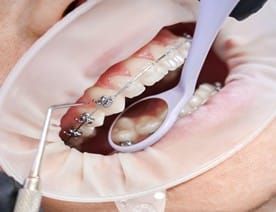 bites closing gap