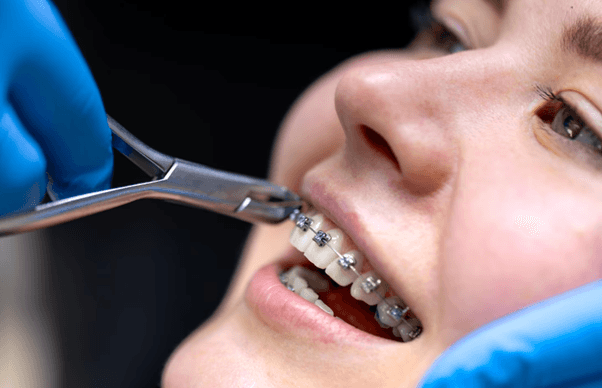 Removal of Orthodontic Mini Screws
