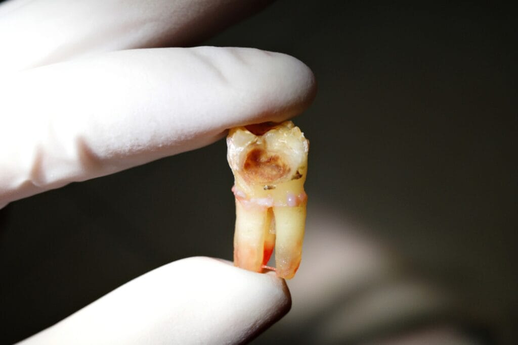 Pulp necrosis