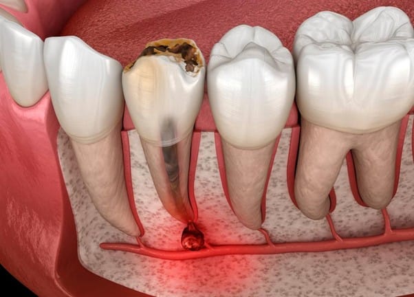 Dental abscess