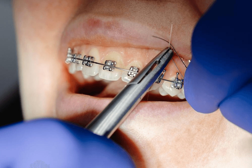 How Long Do Braces Actually Take? | Neo Dental | Neo Dental How Long Do Braces Actually Take?