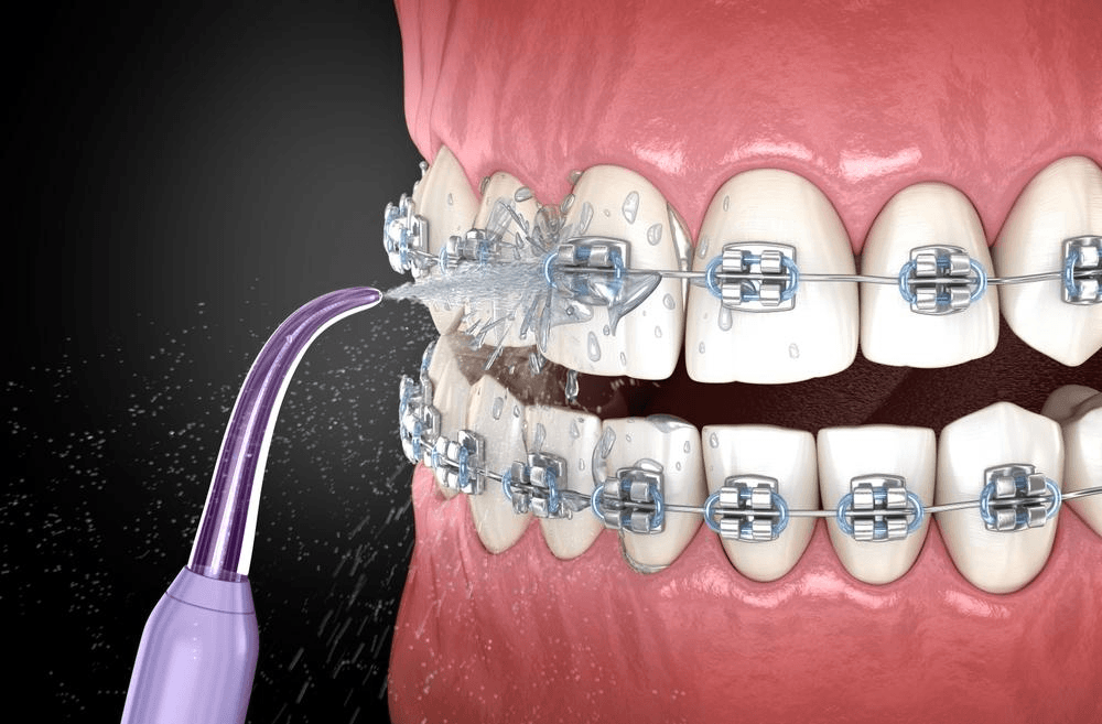 What Factors Affect How Long Braces Take? | Neo Dental | Neo Dental What Factors Affect How Long Braces Take?