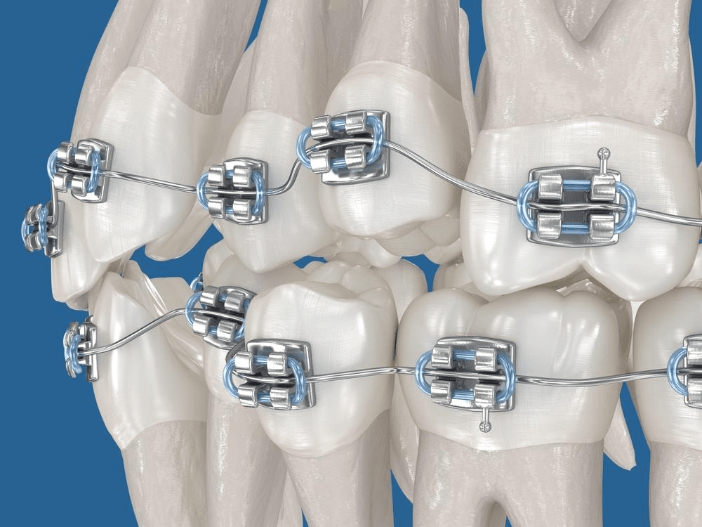 Neo Dental Care's Optimized Braces Timeline Approach | Neo Dental | Neo Dental Neo Dental Care's Optimized Braces Timeline Approach