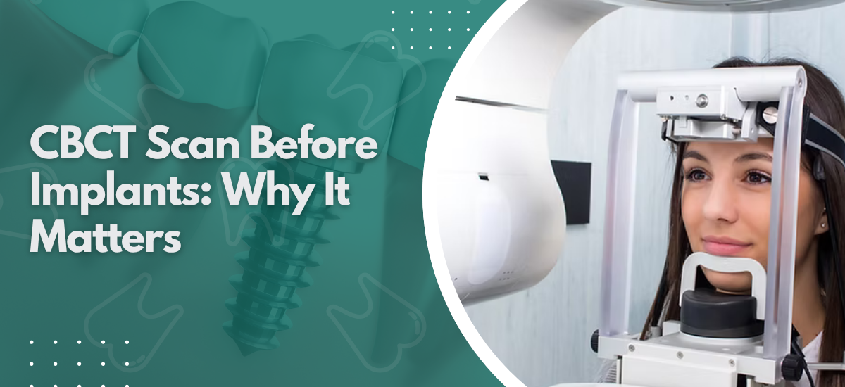 CBCT Scan Before Implants: Why It Matters