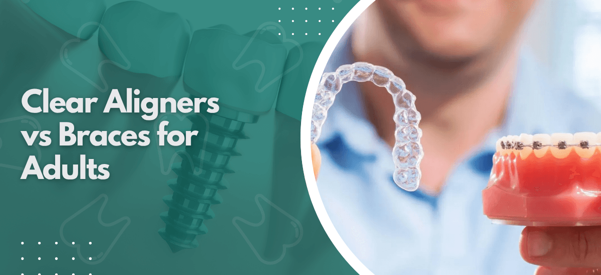 Clear Aligners vs Braces for Adults