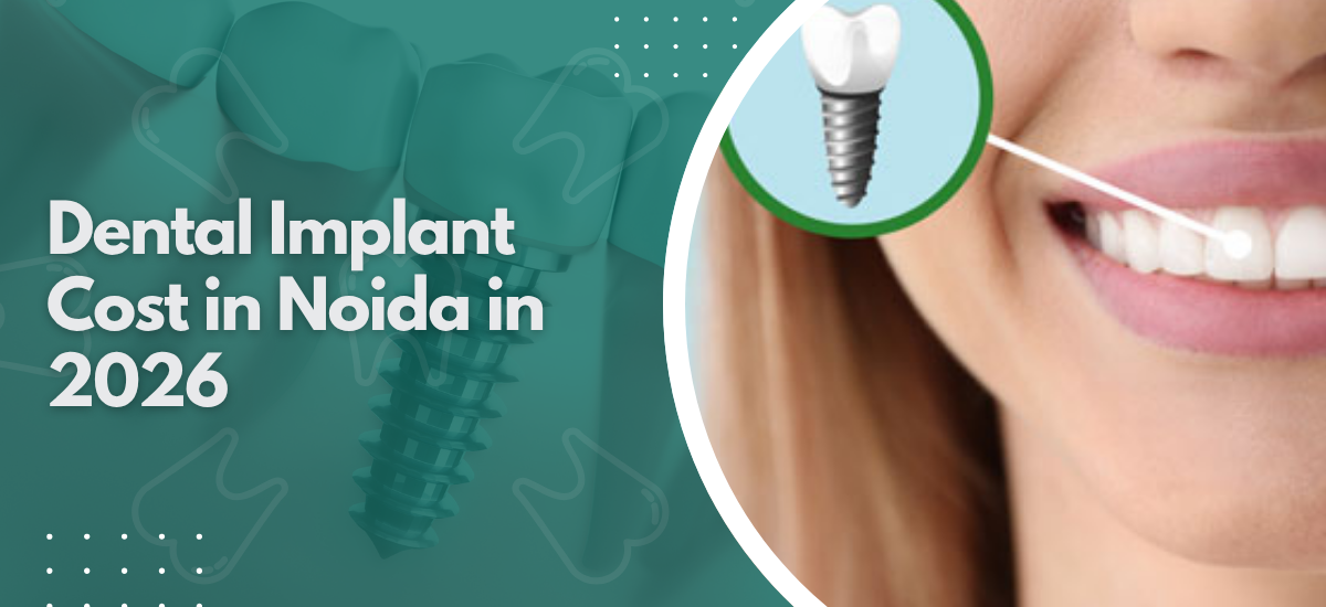 Dental Implant Cost in Noida in 2026