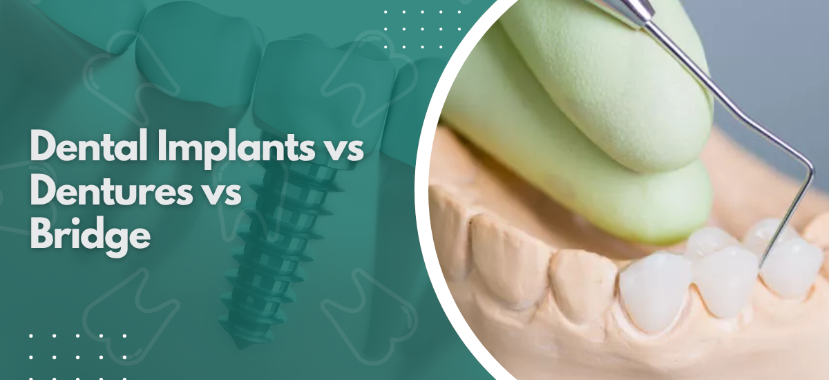Dental Implants vs Dentures vs Bridge