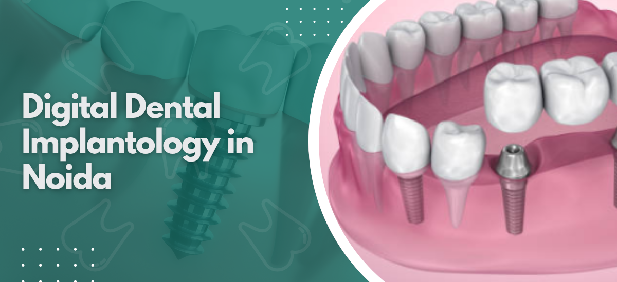 Digital Dental Implantology in Noida