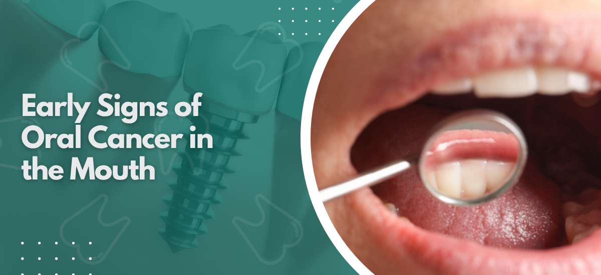Early Signs of Oral Cancer in the Mouth