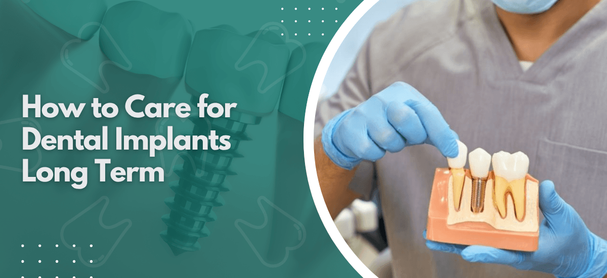 How to Care for Dental Implants Long Term