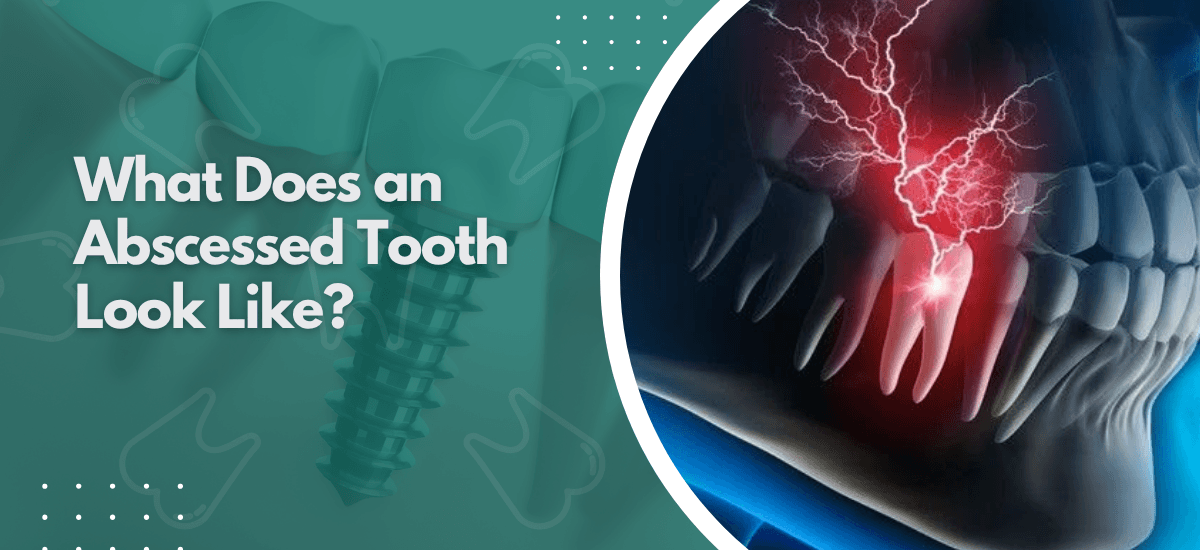 What Does an Abscessed Tooth Look Like?