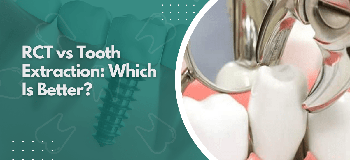 RCT vs Tooth Extraction: Which Is Better?