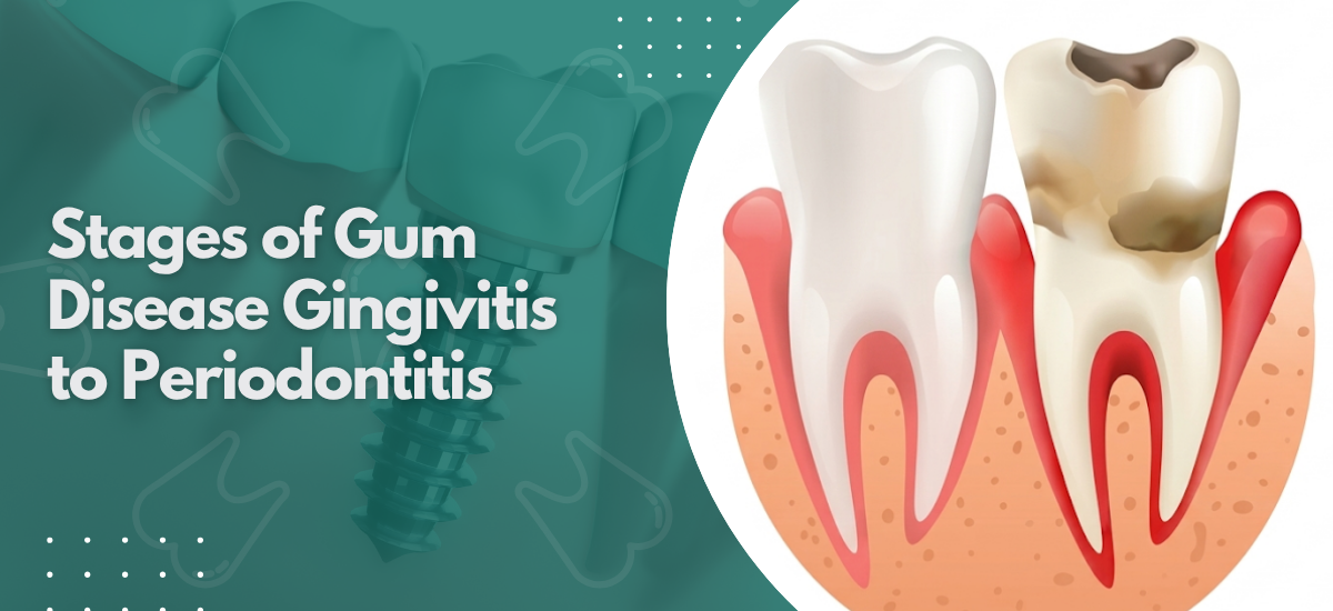 Stages of Gum Disease Gingivitis to Periodontitis