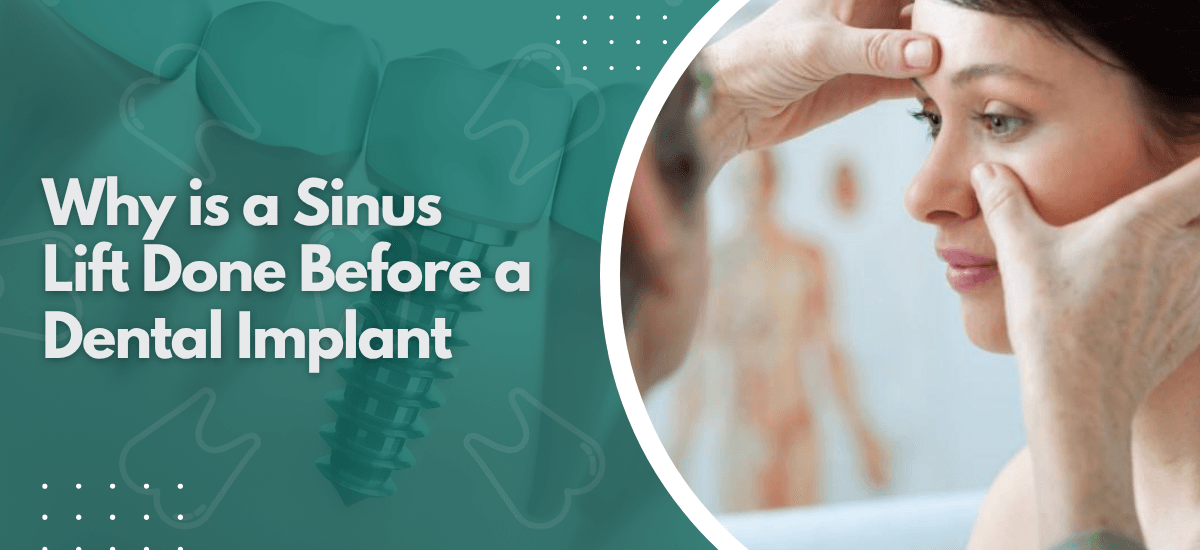 Why is a Sinus Lift Done Before a Dental Implant