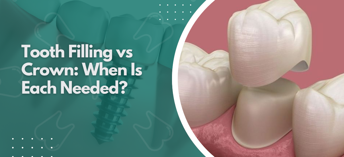 Tooth Filling vs Crown: When Is Each Needed?