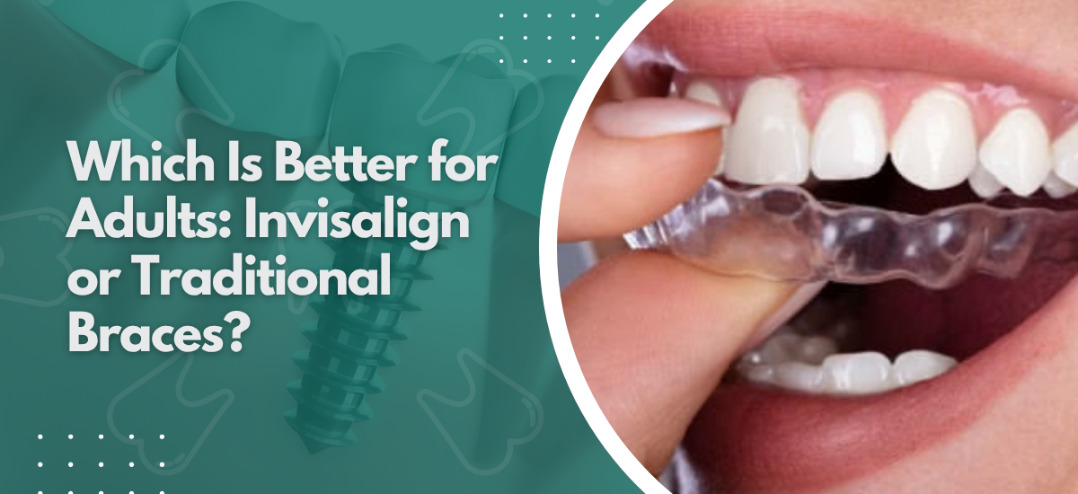 Which Is Better for Adults: Invisalign or Traditional Braces?