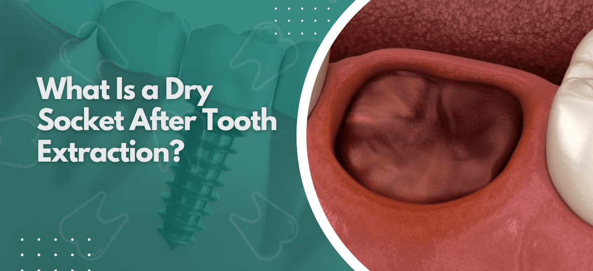 What Is a Dry Socket After Tooth Extraction?