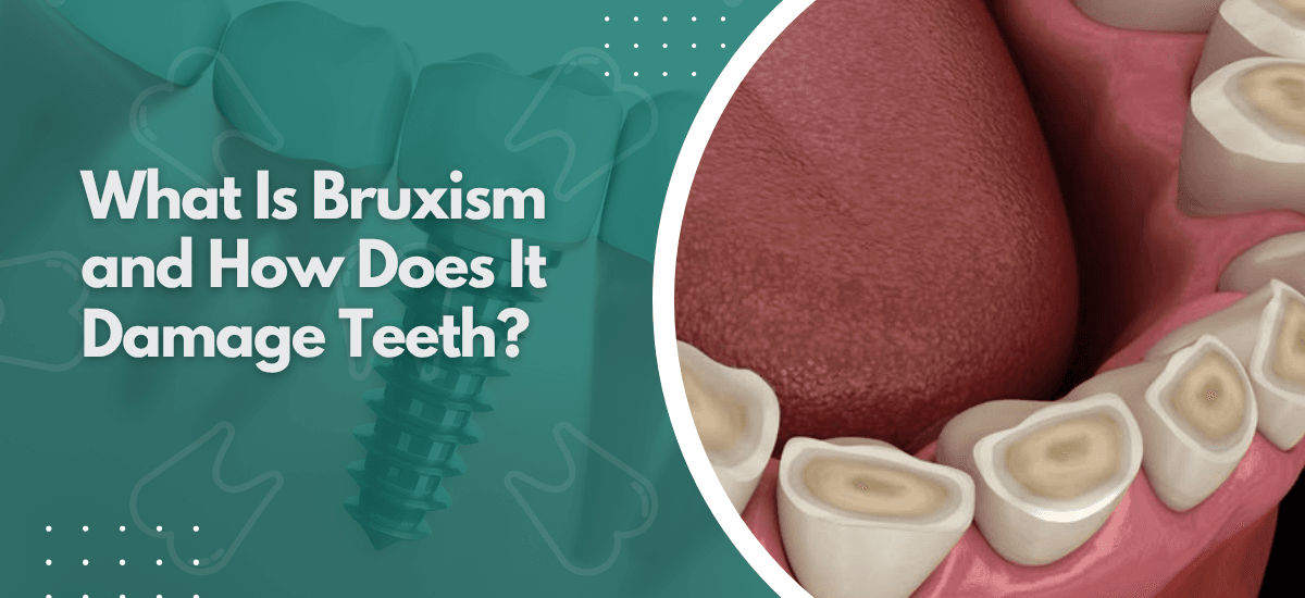 What Is Bruxism and How Does It Damage Teeth?