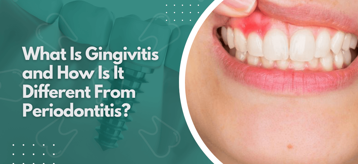 What Is Gingivitis and How Is It Different From Periodontitis?
