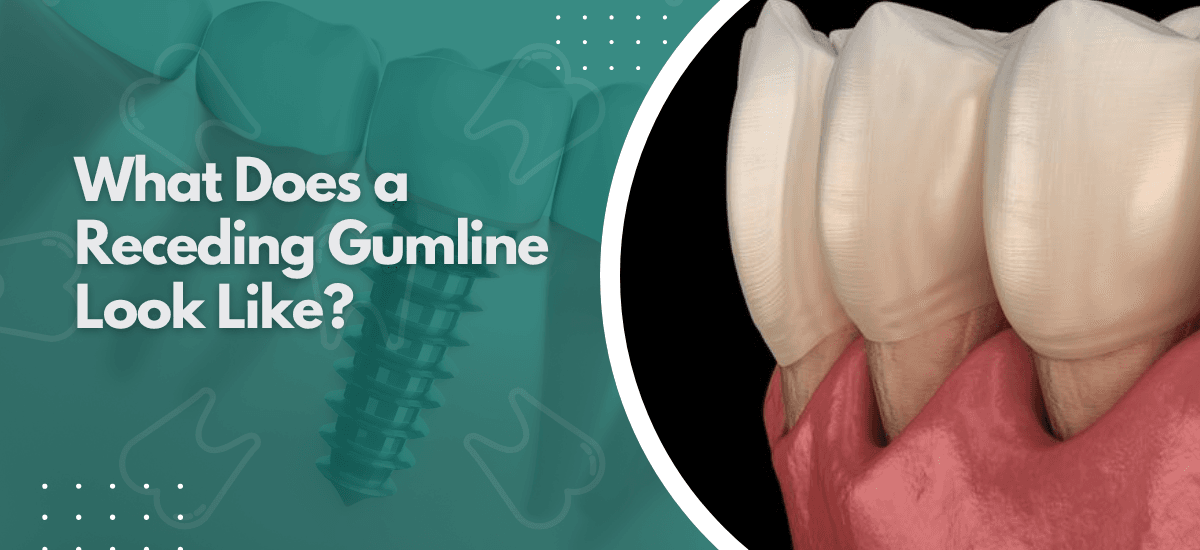 What Does a Receding Gumline Look Like?