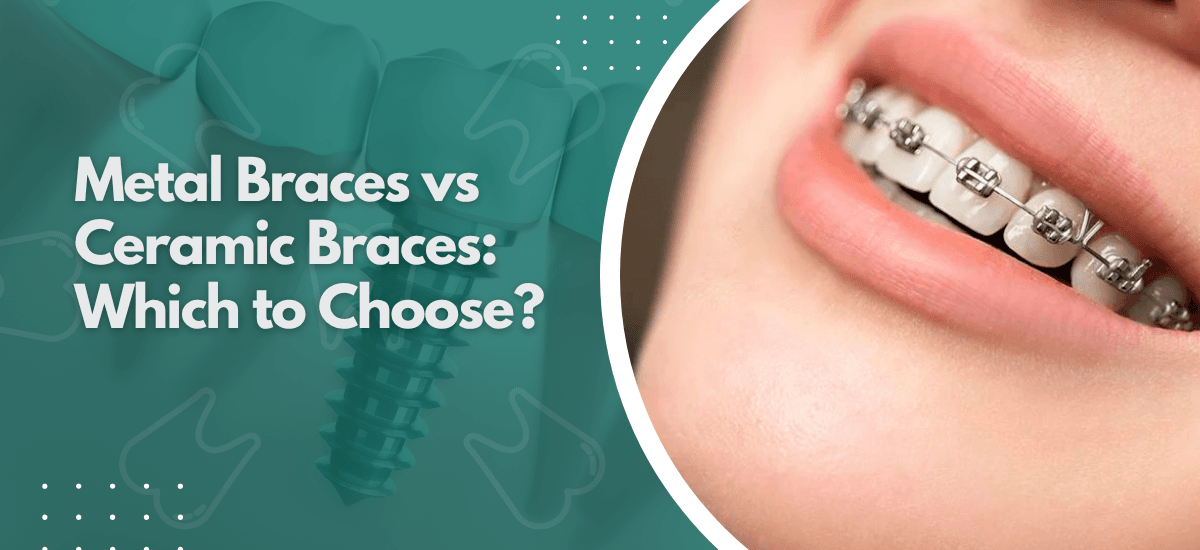 Metal Braces vs Ceramic Braces: Which to Choose?