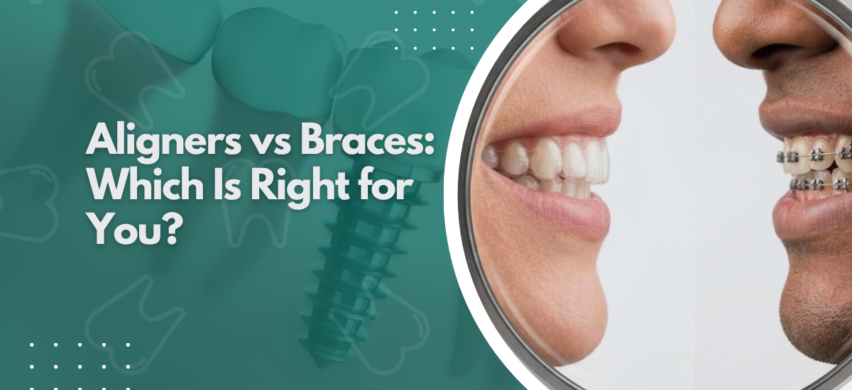 Aligners vs Braces:Which Is Right for You?
