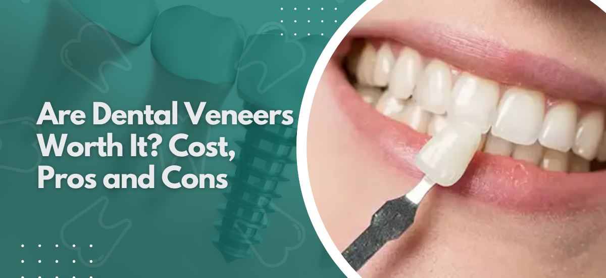 Are Dental Veneers Worth It? Cost, Pros and Cons?