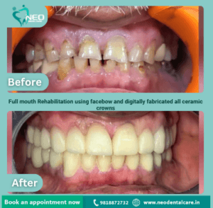 Two-panel before-and-after showing teeth improved from discolored, crowded to straight, white after full-mouth rehabilitation with ceramic crowns (top: before, bottom: after).