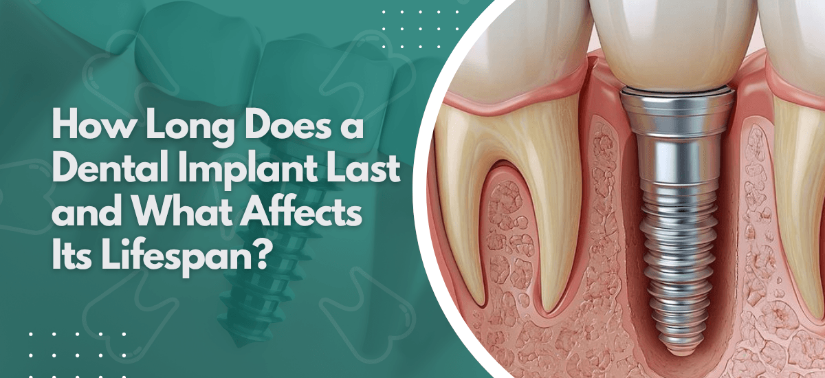 How Long Does a Dental Implant Last and What Affects Its Lifespan?