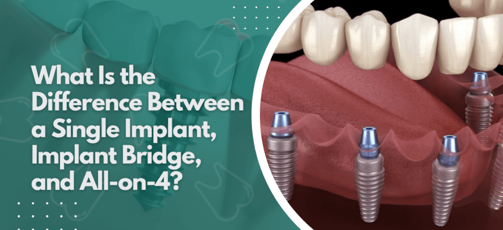 Neo Dental - blogs 18 | Neo Dental | Neo Dental Not sure which implant option suits your case? Dr. Suhrab Singh explains the key differences between a single implant, implant bridge, and All-on-4 in plain terms.