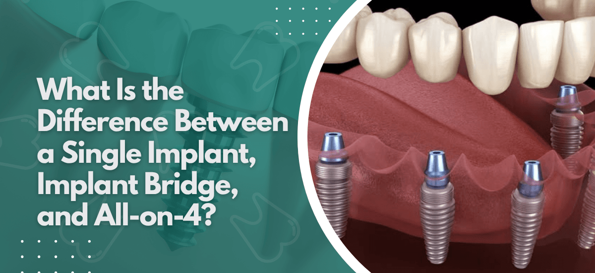 What Is the Difference Between a Single Implant, Implant Bridge, and All-on-4?