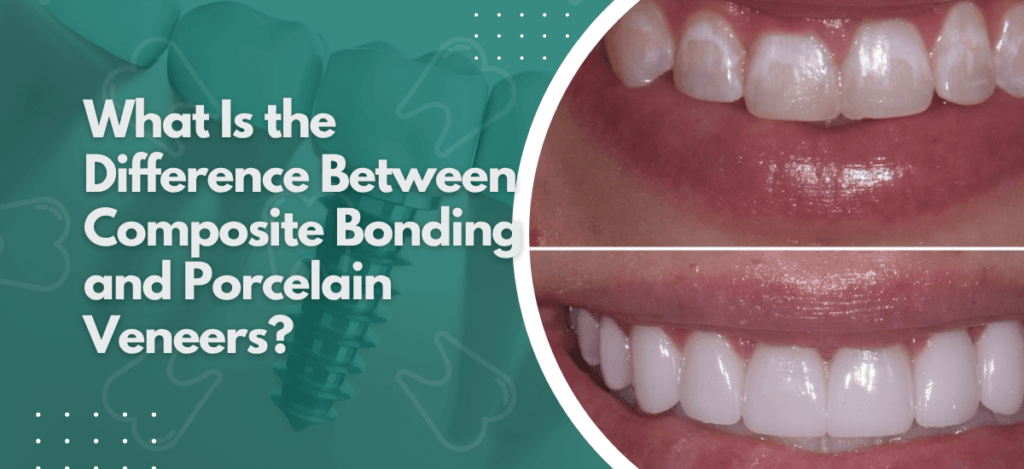 Neo Dental - blogs 24 | Neo Dental | Neo Dental What Is the Difference Between Composite Bonding and Porcelain Veneers?