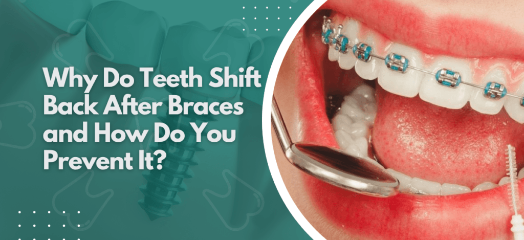 Neo Dental - blogs 25 | Neo Dental | Neo Dental Teeth shifting after braces is common. Dr. Suhrab Singh explains why orthodontic relapse happens and what retention strategies reliably prevent it.