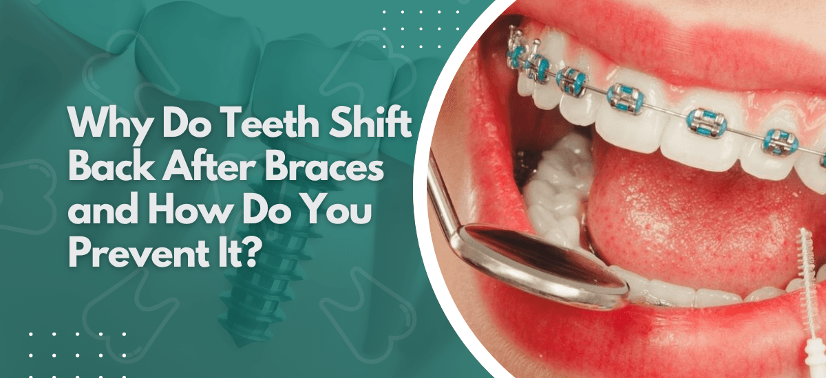Why Do Teeth Shift Back After Braces and How Do You Prevent It?
