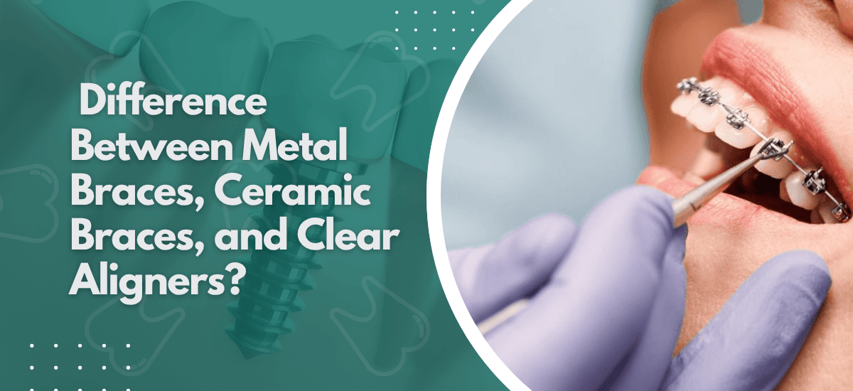 What Is the Difference Between Metal Braces, Ceramic Braces, and Clear Aligners?