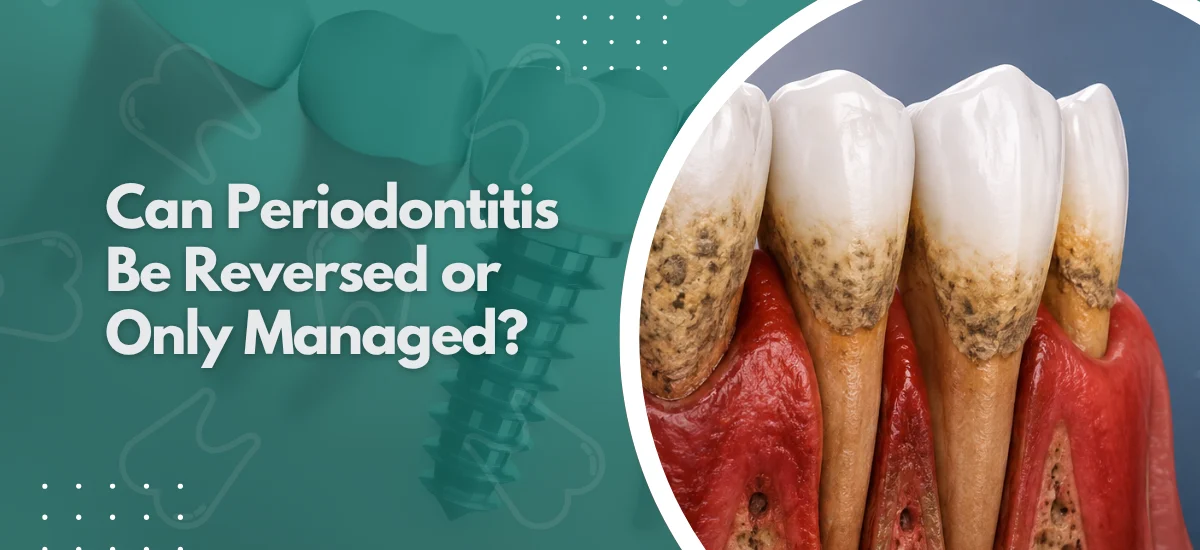Can Periodontitis Be Reversed or Only Managed?