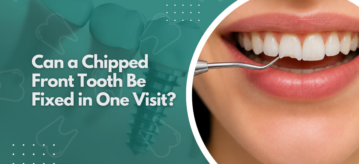 Can a Chipped Front Tooth Be Fixed in One Visit?